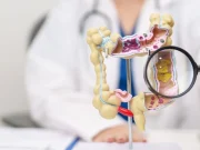 Ракот на дебелото црево е во пораст кај младите луѓе: „Никој не е премлад за оваа дијагноза“